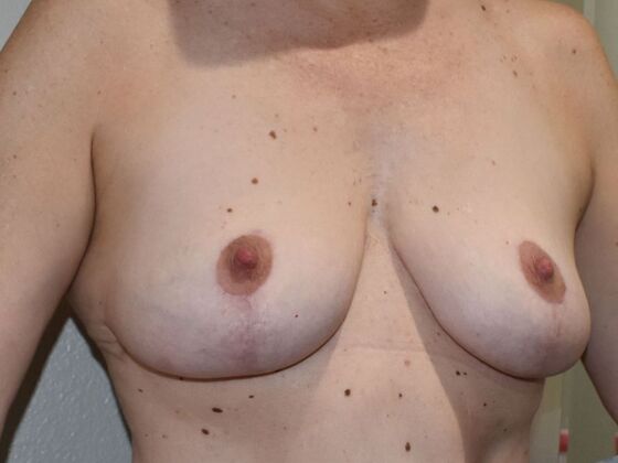 Breast Lift (Mastopexy): Case 218 - After