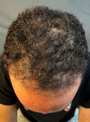 FUE Hair Restoration: Case 40 - Before