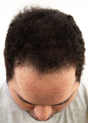 FUE Hair Restoration: Case 40 - After