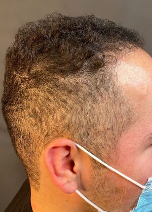 FUE Hair Restoration: Case 40 - Before