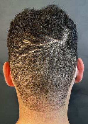 FUE Hair Restoration: Case 40 - Before