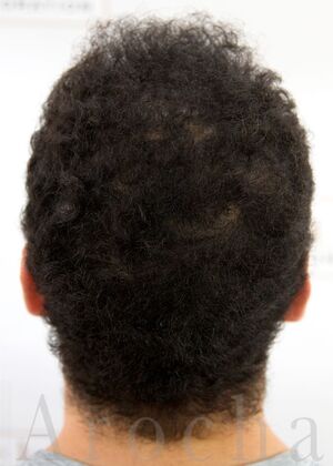 FUE Hair Restoration: Case 40 - After