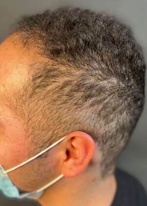 FUE Hair Restoration: Case 40 - Before