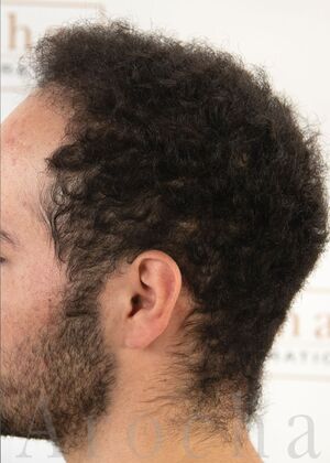 FUE Hair Restoration: Case 40 - After