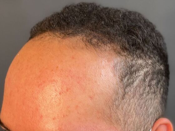 FUE Hair Restoration: Case 40 - Before