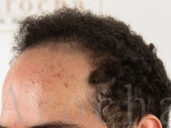 FUE Hair Restoration: Case 40 - After