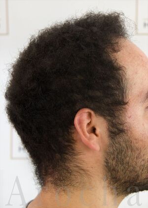 FUE Hair Restoration: Case 40 - After