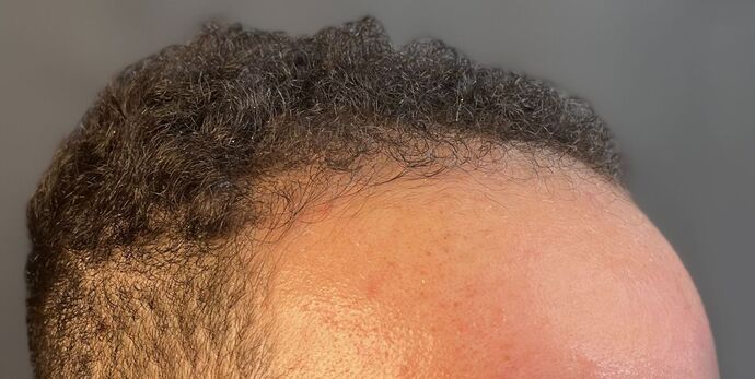 FUE Hair Restoration: Case 40 - Before