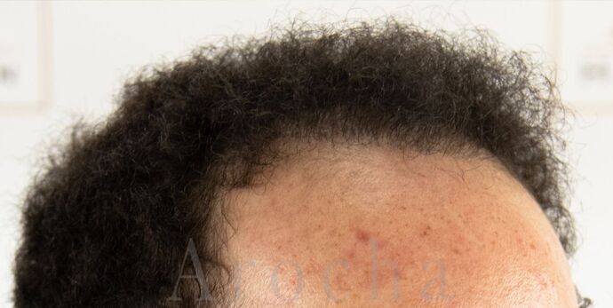 FUE Hair Restoration: Case 40 - After