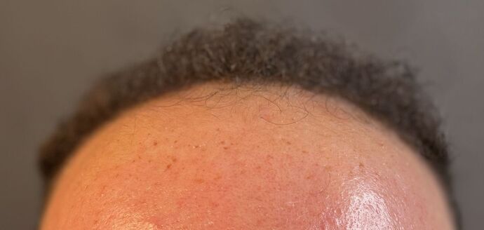 FUE Hair Restoration: Case 40 - Before