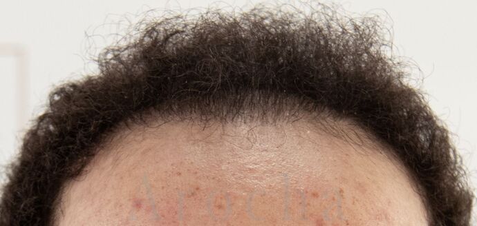 FUE Hair Restoration: Case 40 - After