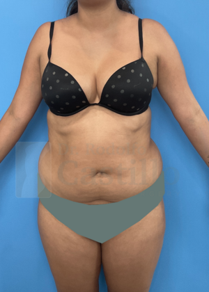 Tummy Tuck: Tummy Tuck - Before