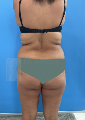 Tummy Tuck: Tummy Tuck - Before