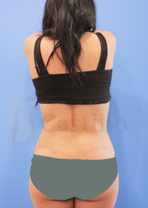 Tummy Tuck: Tummy Tuck - After