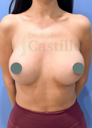 Breast Augmentation: Breast Augmentation - After