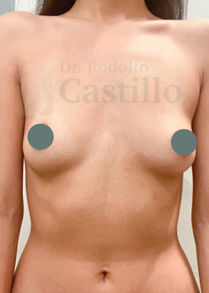 Breast Augmentation: Breast Augmentation - Before