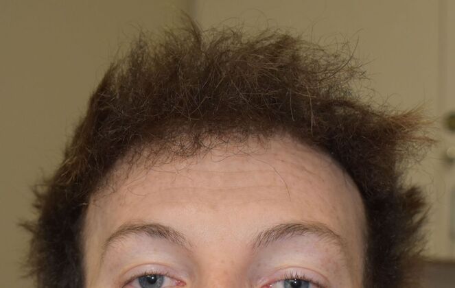 Hair Transplantation: Case 5 - After