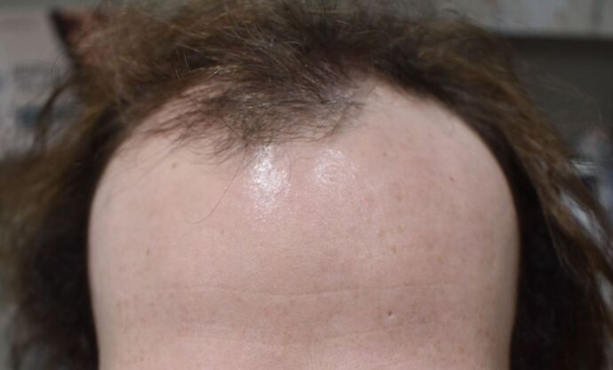 Hair Transplantation: Case 5 - Before