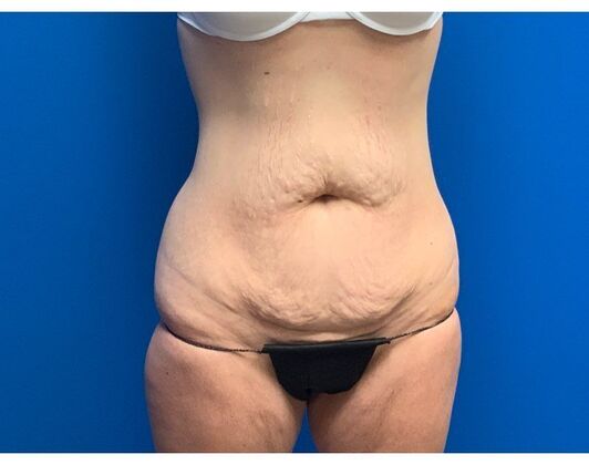 Abdominoplasty Case 38 - Before