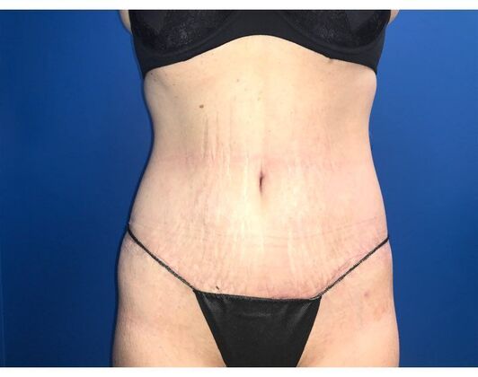 Abdominoplasty Case 38 - After