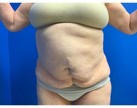 Abdominoplasty Case 39 - Before