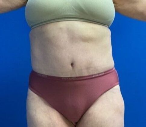 Abdominoplasty Case 39 - After