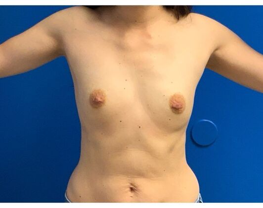 Breast Augmentation Case 39 - Before