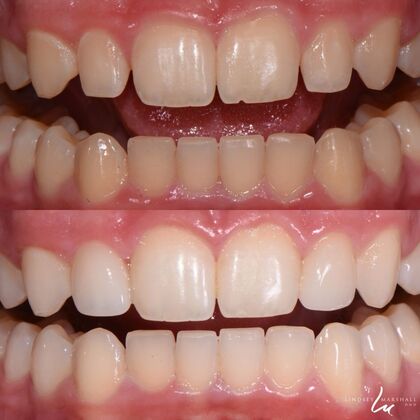 Before And After Transformations Case 1