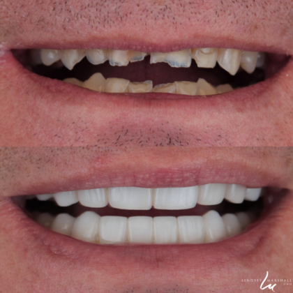 Before And After Transformations Case 4