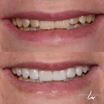 Before And After Transformations Case 7