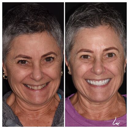 Before And After Transformations Case 10