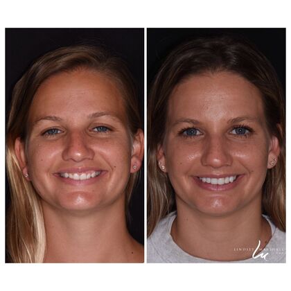 Before And After Transformations Case 12