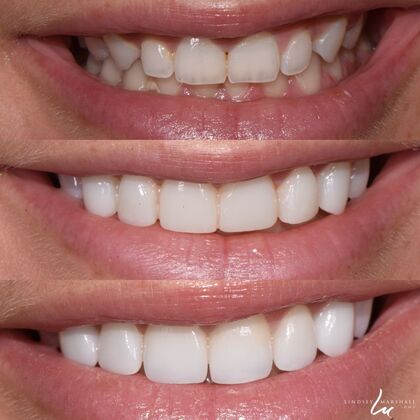 Before And After Transformations Case 13