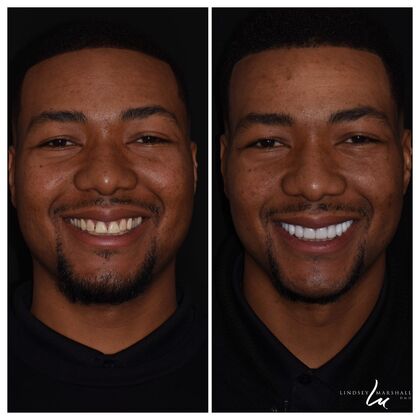 Before And After Transformations Case 14