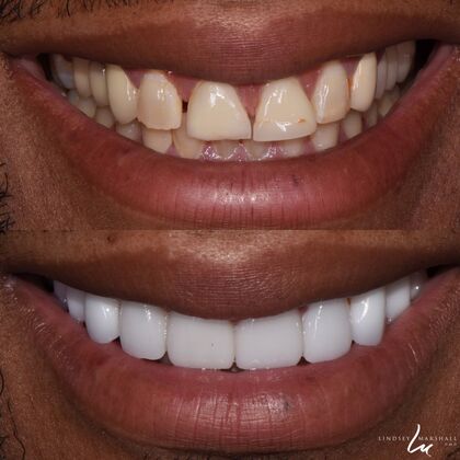 Before And After Transformations Case 15