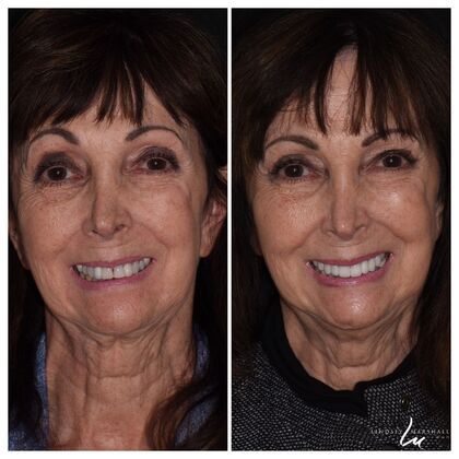 Before And After Transformations Case 16