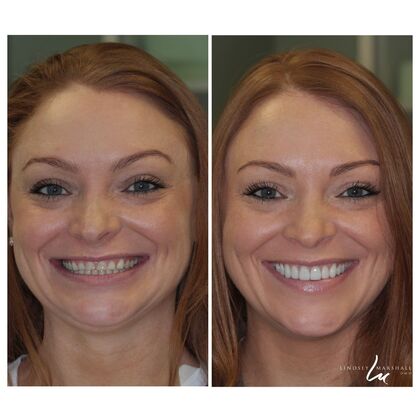 Before And After Transformations Case 17