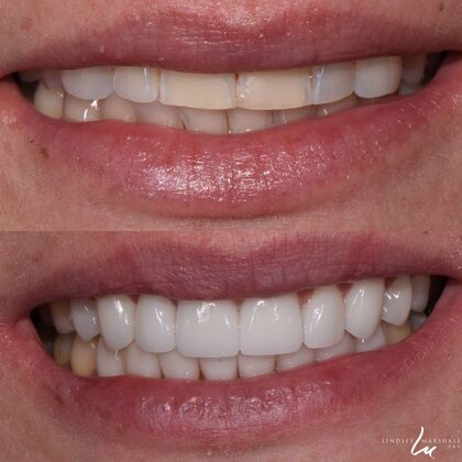 Before And After Transformations Case 18