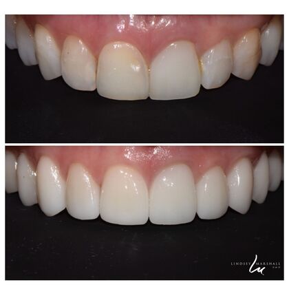 Before And After Transformations Case 20