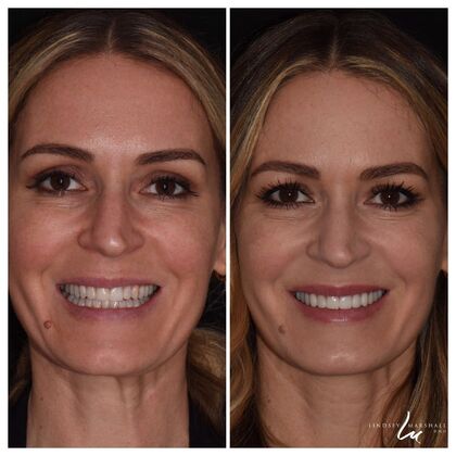 Before And After Transformations Case 21