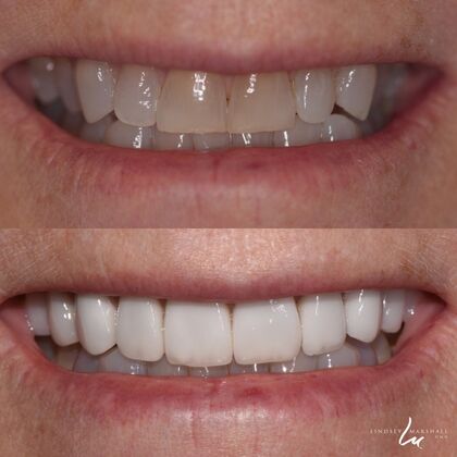 Before And After Transformations Case 22