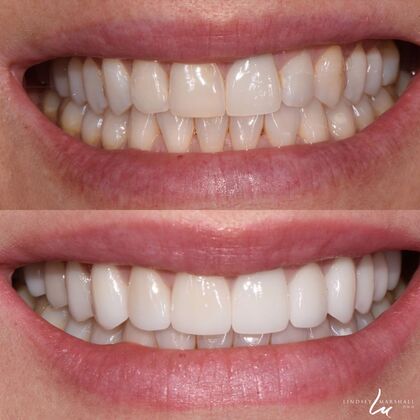 Before And After Transformations Case 23