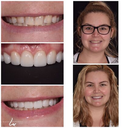 Before And After Transformations Case 27