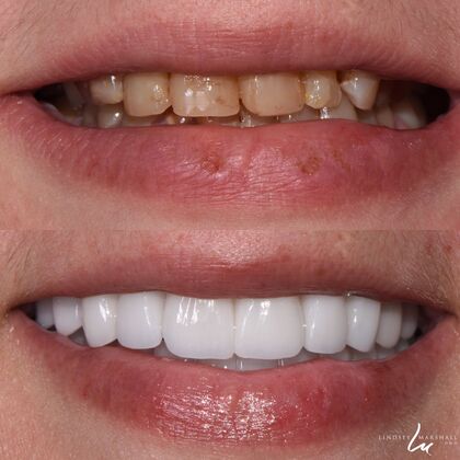 Before And After Transformations Case 28