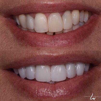 Before And After Transformations Case 29