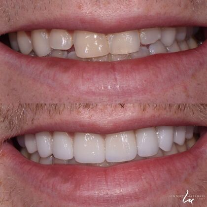 Before And After Transformations Case 30