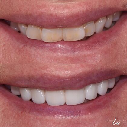 Before And After Transformations Case 31