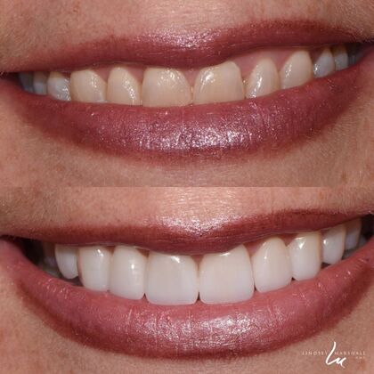 Before And After Transformations Case 32