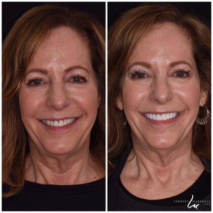 Before And After Transformations Case 34