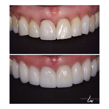 Before And After Transformations Case 35